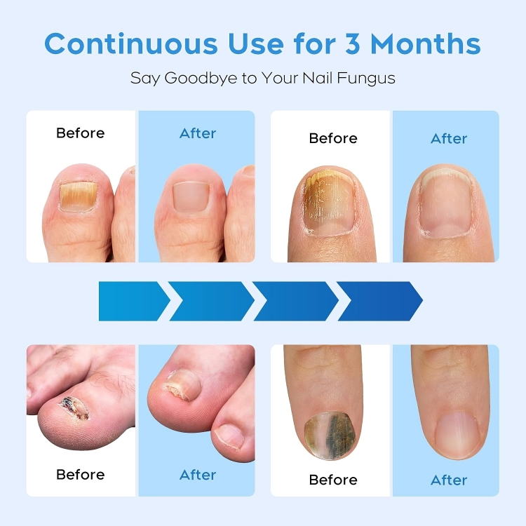 TILLFÄLLIGT 50% RABATT | NailRenew™ | Bekämpa och eliminera nagelsvamp!