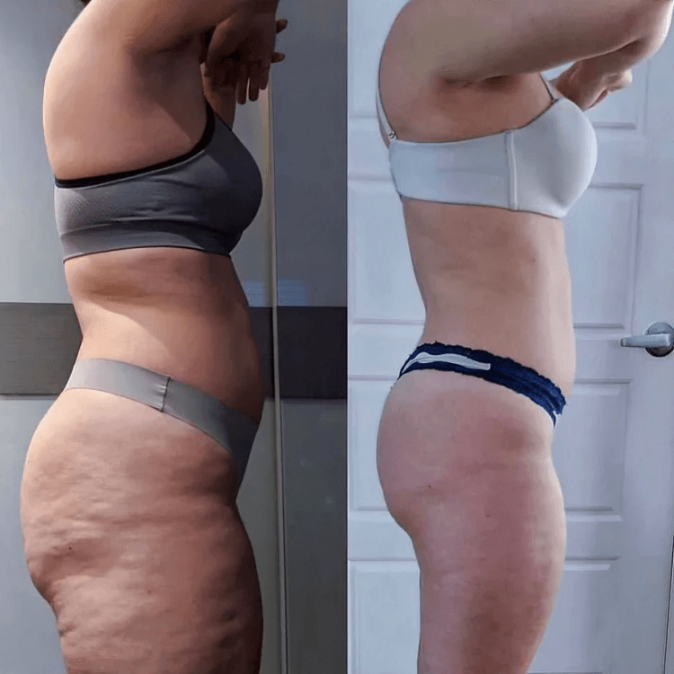 TILLFĂLLIGT 50% RABATT | CelluSootheâą | Elektrisk anti-cellulit kupningsmassageapparat - Aurora Stockholm