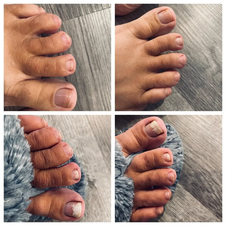 TILLFÄLLIGT 50% RABATT | NailRenew™ | Bekämpa och eliminera nagelsvamp!