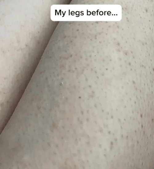 1 + 1 GRATIS IDAG  DermaBare™