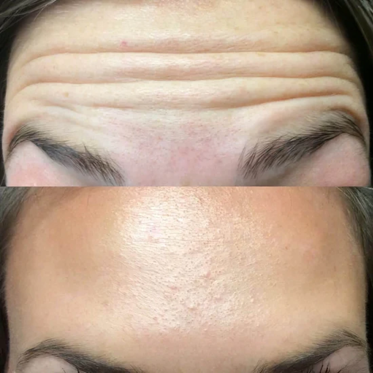 TILLFÄLLIGT 50% RABATT | GlowLift™ | Hemligheten bakom tidlös skönhet!
