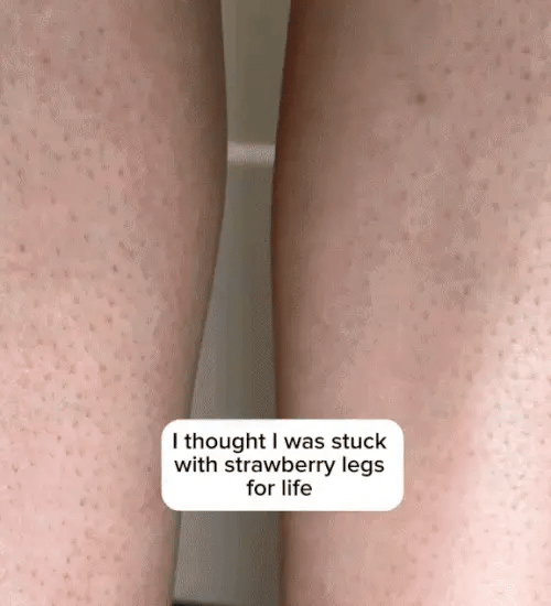 1 + 1 GRATIS IDAG  DermaBare™