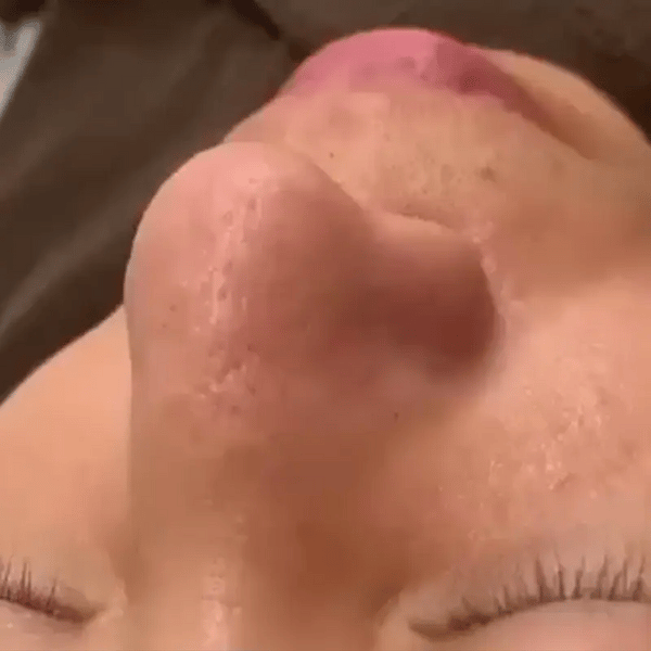 TILLFÄLLIGT 50% OFF  DermaVeo™